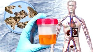 Discover the causes of kidney stones and how to prevent them from forming
