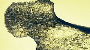 Learn about osteoporosis and the challenges in diagnosis and treatment