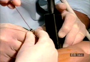 See how ultrasound and chorionic villus biopsy procedures can prenatally screen and diagnose diseases such as cystic fibrosis through DNA amplification and genetic fingerprinting